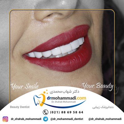 ونیر طرح لبخند